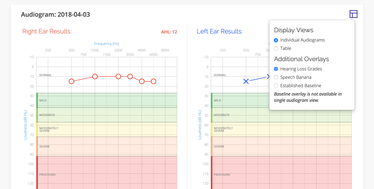A screenshot of the patient's audiogram with the Display Options displayed.
