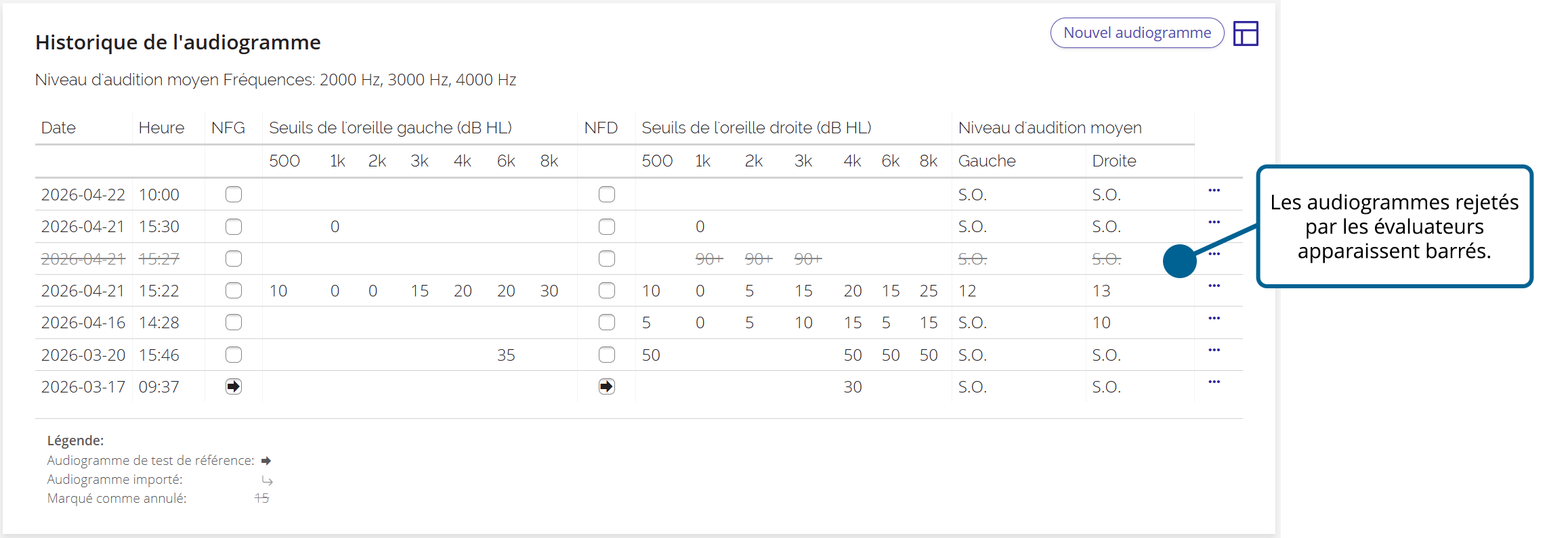 Une capture d'écran de l'historique des audiogrammes du patient, avec un audiogramme barré dans la liste.